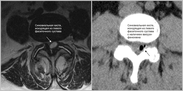 Синовиальная форма образования Синовиальная форма образования