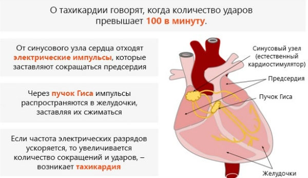 Синусовая тахикардия сердца Синусовая тахикардия сердца