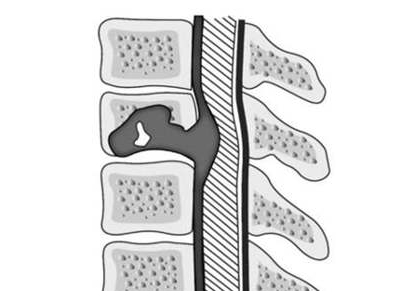 Спинальный эпидуральный абсцесс Спинальный эпидуральный абсцесс