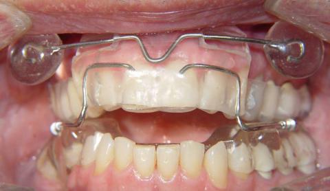 Установка сплинта при артрите ВНЧС Установка сплинта при артрите ВНЧС