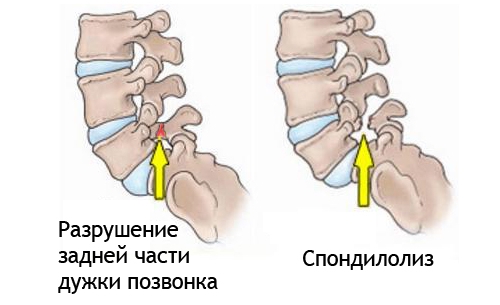 Спондилолиз Спондилолиз