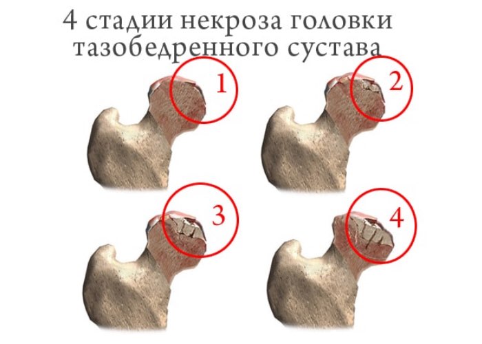 Стадии некроза головки бедренной кости Стадии некроза головки бедренной кости