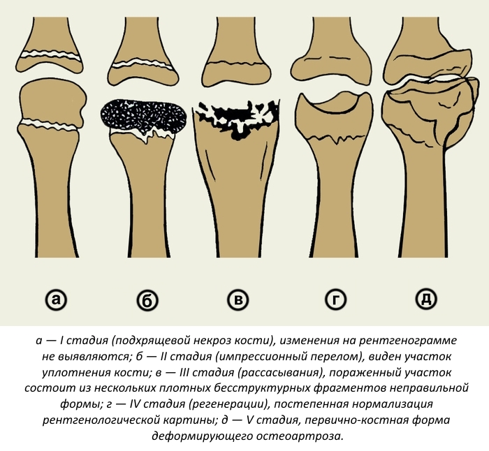 Стадии остеохондропатии Стадии остеохондропатии