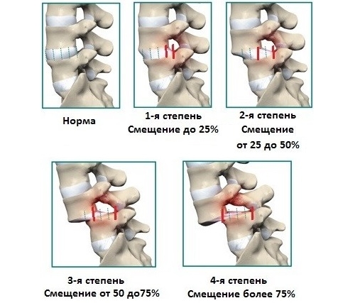 Степени ретролистеза Степени ретролистеза
