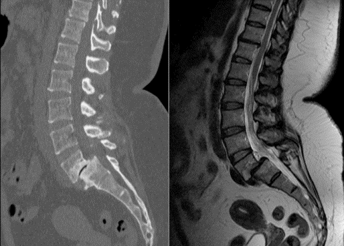 Стойкая люмбоишиалгия на МРТ Стойкая люмбоишиалгия на МРТ