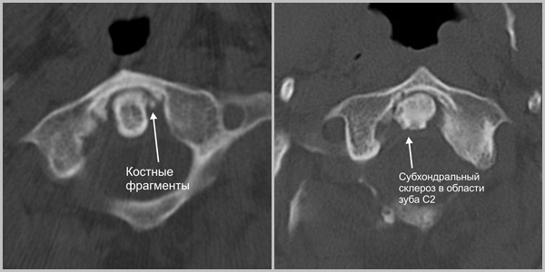 МРТ сустава Крювелье МРТ сустава Крювелье