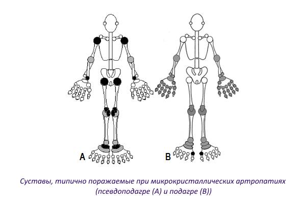 Суставы, типично поражаемые при подагре и псевдоподагре Суставы, типично поражаемые при подагре и псевдоподагре