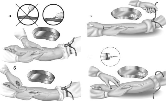 Техника внутривенной инъекции Техника внутривенной инъекции