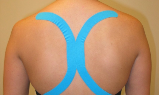 Тейпирование грудного отдела позвоночника Тейпирование грудного отдела позвоночника