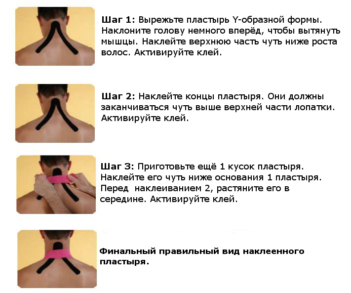 Тейпирование при боли в шейном отделе Тейпирование при боли в шейном отделе