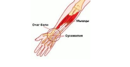 Тендиноз запястья Тендиноз запястья