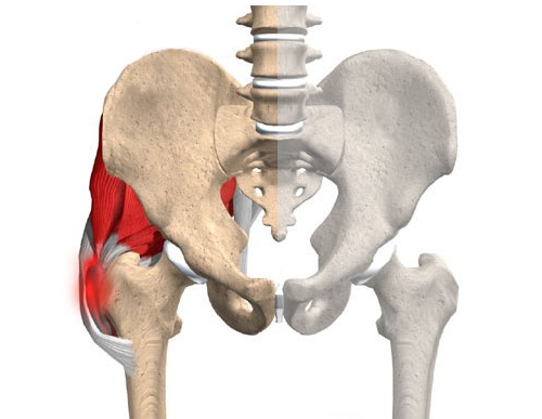 Тендиноз тазобедренного сустава Тендиноз тазобедренного сустава