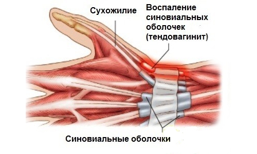 Тендовагинит Тендовагинит