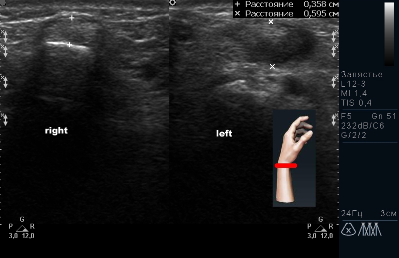 Теносиновит кисти на УЗИ Теносиновит кисти на УЗИ