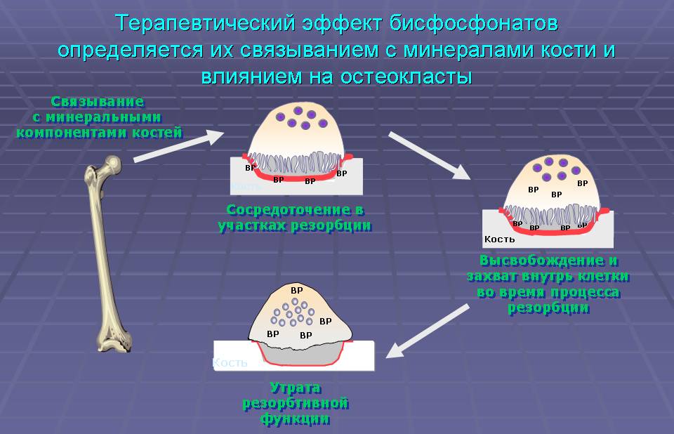 Терапевтический эффект бисфосфонатов Терапевтический эффект бисфосфонатов