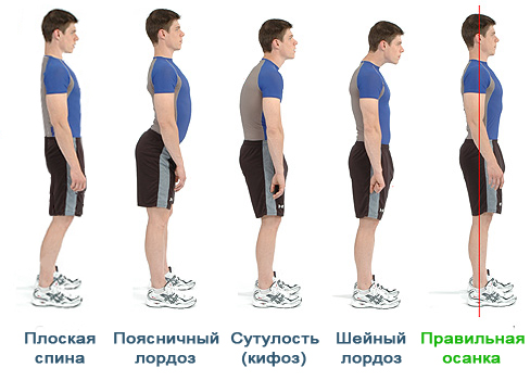 Типы осанки при лордозе Типы осанки при лордозе