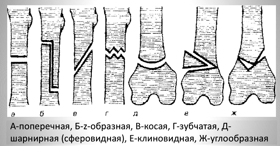 Типы остеотомии по форме разреза Типы остеотомии по форме разреза