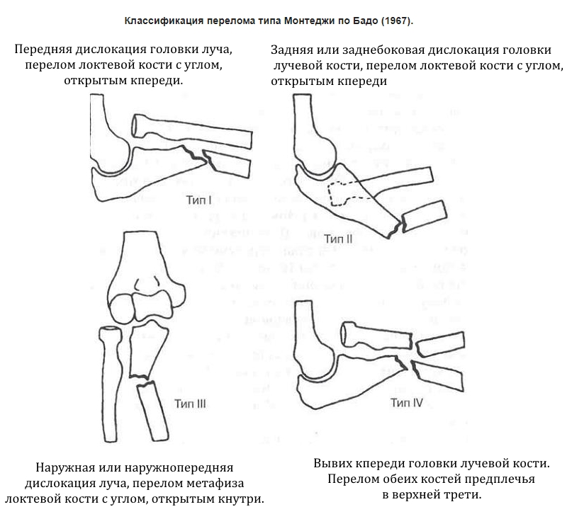 Типы переломов локтевой кости по Монтеджи Типы переломов локтевой кости по Монтеджи
