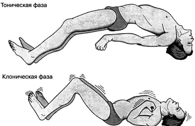 Тонические и клонические судороги Тонические и клонические судороги
