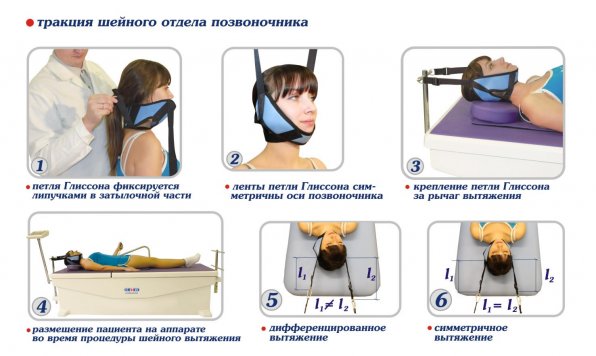 Тракция шейного отдела позвоночника Тракция шейного отдела позвоночника