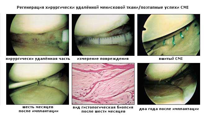 Трансплантация мениска Трансплантация мениска