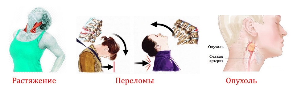 Травмирование шеи Травмирование шеи