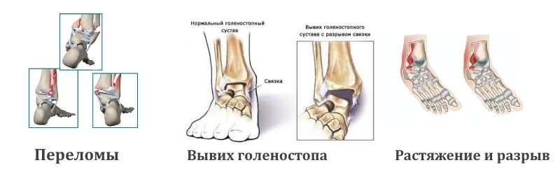 Травмы голеностопа Травмы голеностопа