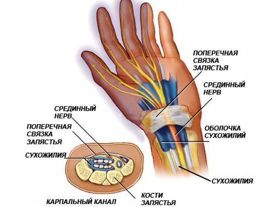 Туннельный синдром запястья кисти Туннельный синдром запястья кисти