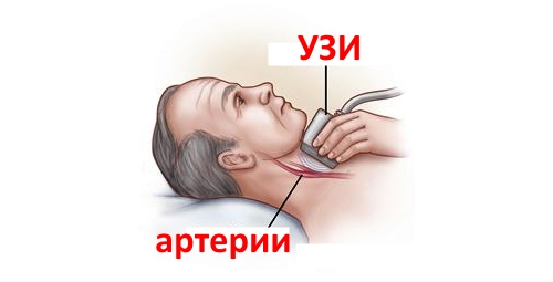 УЗИ сосудов шеи УЗИ сосудов шеи