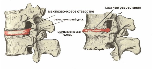 Уменьшение высоты межпозвоночного диска Уменьшение высоты межпозвоночного диска