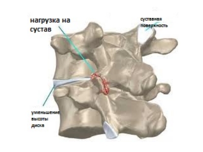Уменьшение высоты межпозвоночного хряща — противопоказание к нуклеопластике Уменьшение высоты межпозвоночного хряща — противопоказание к нуклеопластике