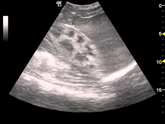 Уратный нефролитиаз на УЗИ Уратный нефролитиаз на УЗИ
