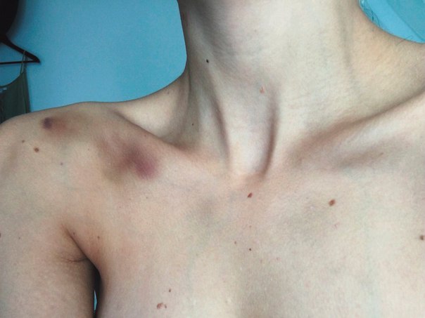 Гематомы при ушибе ключицы