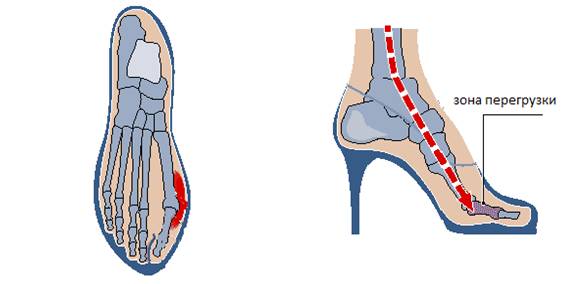 Вальгусная деформация большого пальца из-за ношения туфель на каблуке Вальгусная деформация большого пальца из-за ношения туфель на каблуке