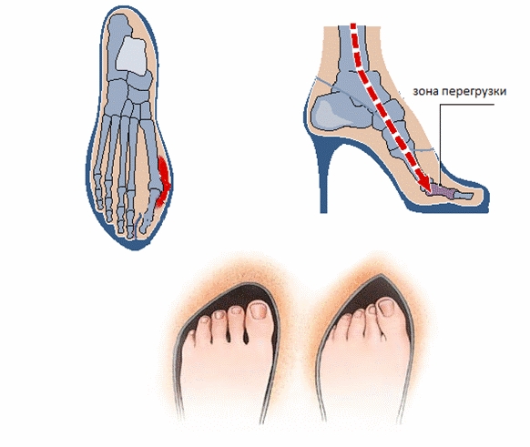 Вальгусная деформация из-за обуви Вальгусная деформация из-за обуви