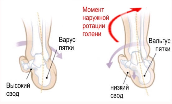 Вальгусная и варусная деформация стопы Вальгусная и варусная деформация стопы