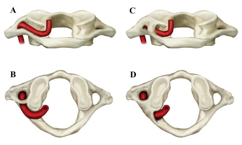 Варианты аномалии Киммерле Варианты аномалии Киммерле