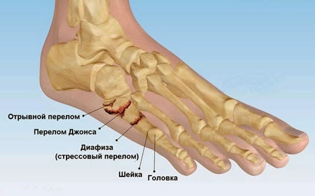 Варианты переломов кости мизинца Варианты переломов кости мизинца