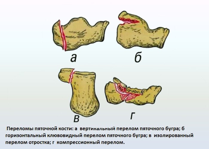 Варианты переломов пяточной кости Варианты переломов пяточной кости
