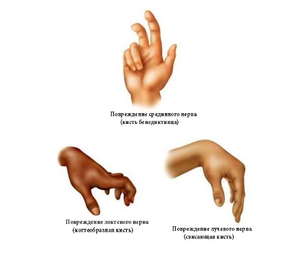 Вид кисти при поражении периферических нервов Вид кисти при поражении периферических нервов