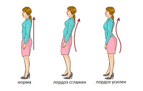 Виды лордоза Виды лордоза