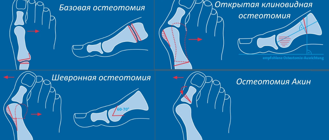 Виды остеотомии при вальгусной деформации большого пальца стопы Виды остеотомии при вальгусной деформации большого пальца стопы