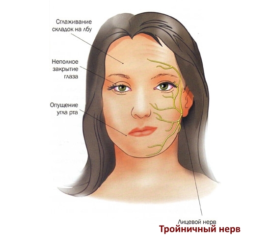 Защемление или неврит тройничного нерва Защемление или неврит тройничного нерва