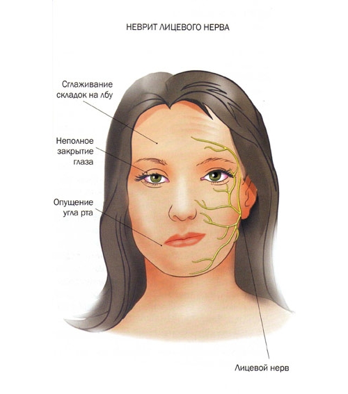 Визуальные признаки неврита лицевого нерва Визуальные признаки неврита лицевого нерва