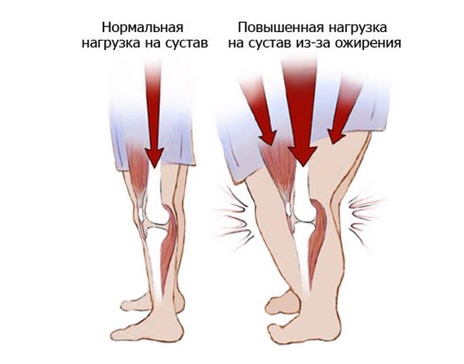 Влияние лишнего веса на суставы Влияние лишнего веса на суставы