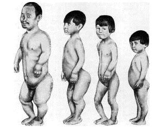 Внешний вид человека с несовершенным остеогенезом Внешний вид человека с несовершенным остеогенезом