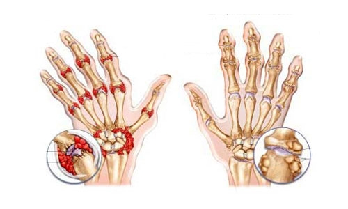 Воспаление суставов Воспаление суставов