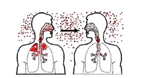 Воздушно-капельный путь заражения туберкулезом Воздушно-капельный путь заражения туберкулезом