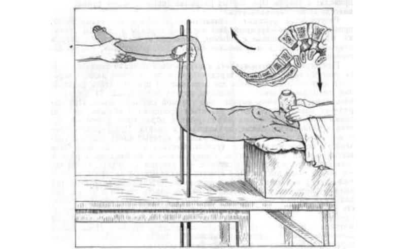 Вправление спондилолистеза Вправление спондилолистеза