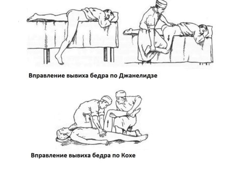 Вправление вывиха бедра по Джанелидзе и Кохеру Вправление вывиха бедра по Джанелидзе и Кохеру
